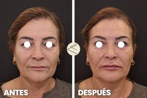 Antes y después aumento de labios acido hialurónico