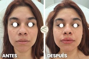 Antes y después aumento de labios en Sevilla acido hialurónico