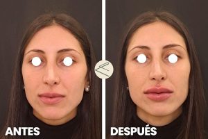 Antes y después aumento de labios en Sevilla acido hialurónico