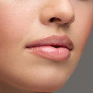 Aumento labios con acido hialurónico en Sevilla. Clinica de Medicina Estética Aestheticlinic