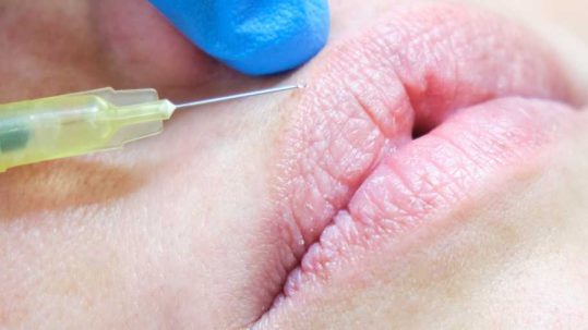 labios rusos o russian lips. Técnica tratamiento labios en Aestheticlinic Sevilla