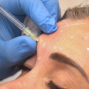 Botox en frente. Paciente de la Clínica de medicina estetica Sevilla Aestheticlinic