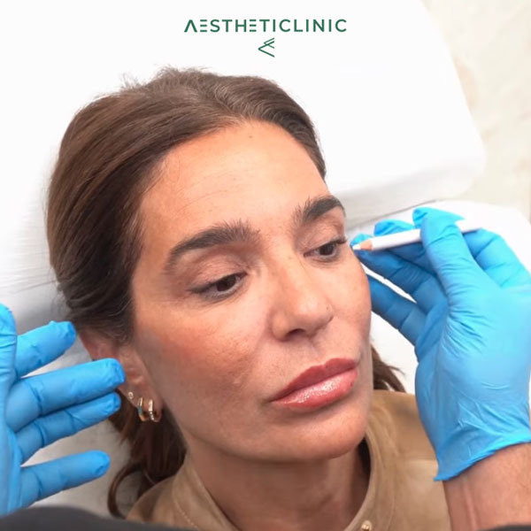 Botox Raquel Bollo paciente Clínica Aestheticlinic Botox Raquel Bollo paciente Clínica Aestheticlinic