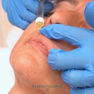 Aumento de labios paciente Clínica Aestheticlinic