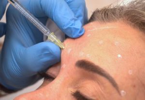 Sculptra: Aplicación del Tratamiento a nuestra paciente de la Clínica AesthetiClinic