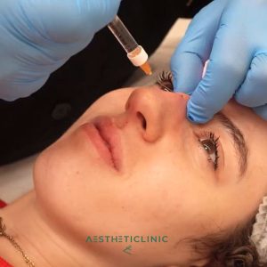 Rinomodelación paciente clínica Aestheticlinic