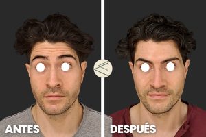 botox antes y después eliminar arrugas frente