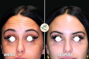 botox arrugas-frente paciente Clinica Aestheticlinic
