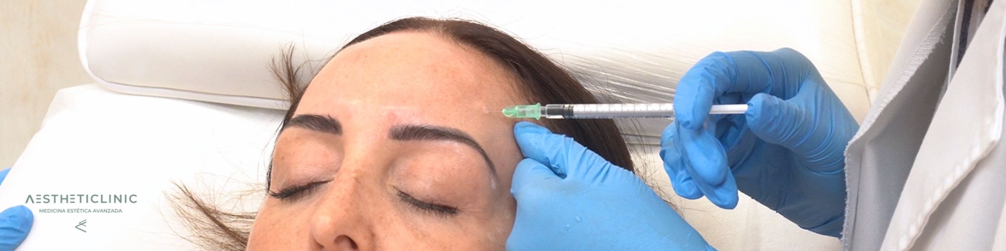 Quitar arrugas frente botox paciente aestheticlinic