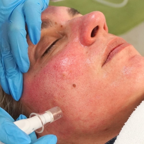 limpieza facial profunda sevilla ventajas limpieza facial profunda sevilla ventajas